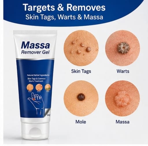 Massa Remover Gel (BCMR) – Skin Tag & Wart Removal Treatment