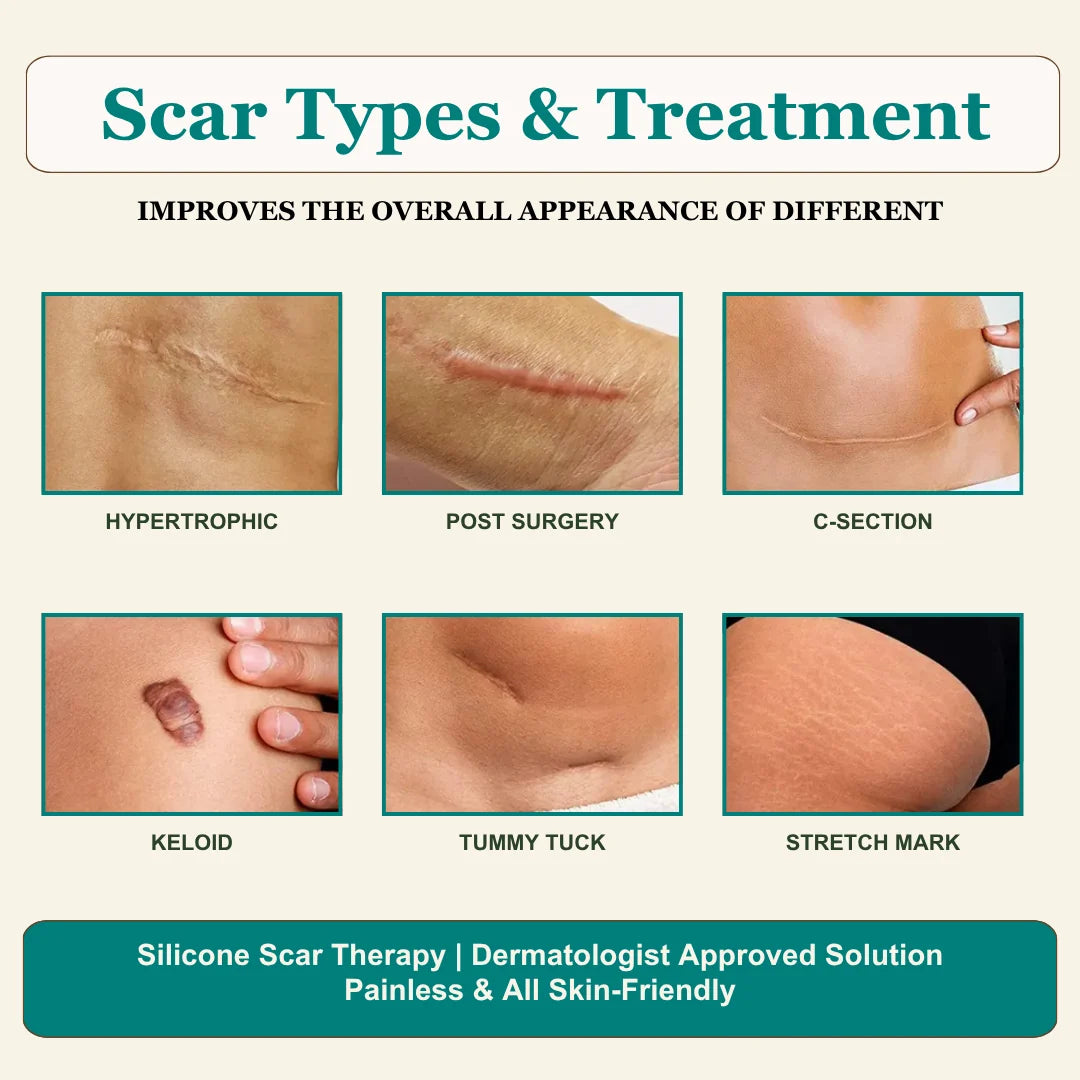 Silicone Scar Remover Tape for Acne & Wrinkles